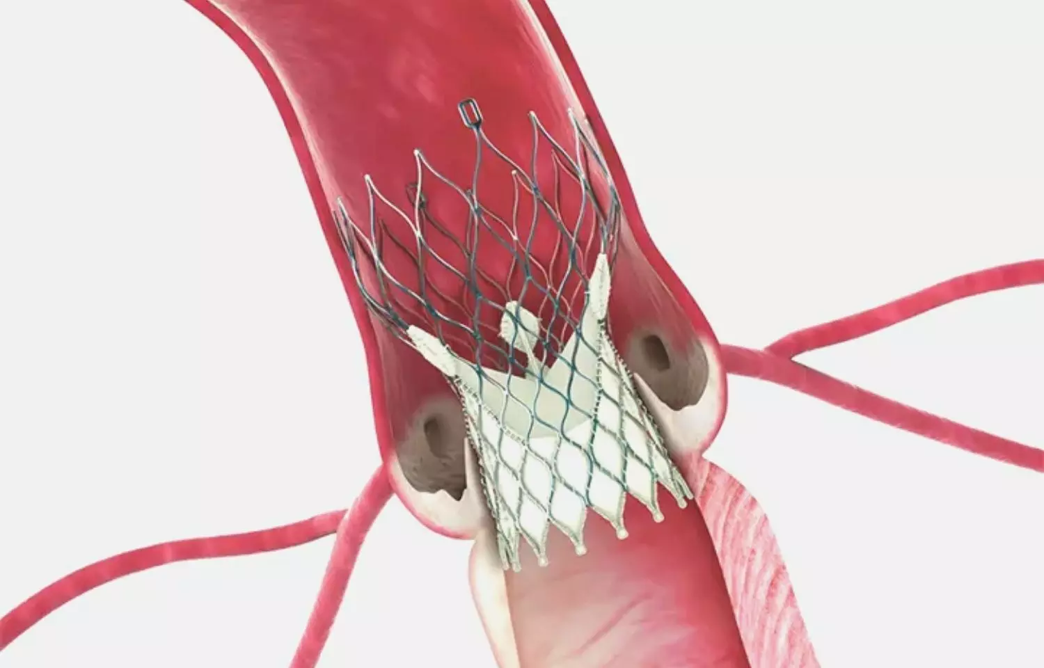 self-expanding-valve-tavr