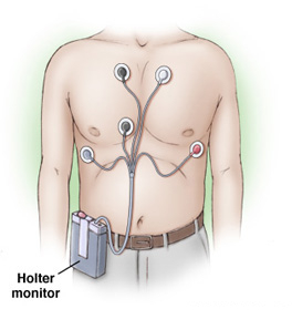 24Hrs Holter