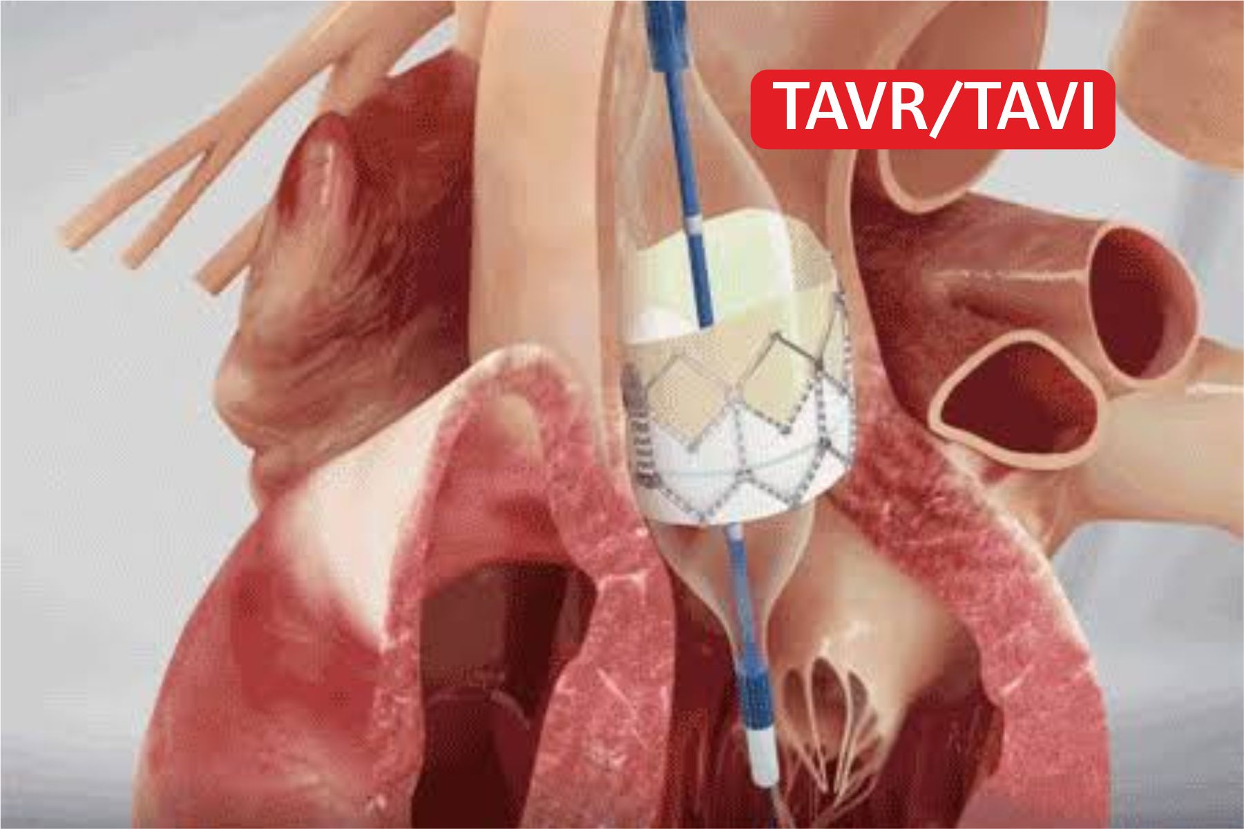 TAVR-TAVI