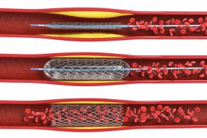 Angioplasty