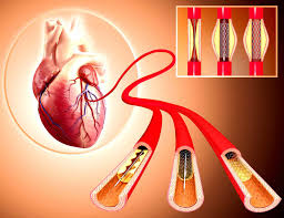 Angioplasty