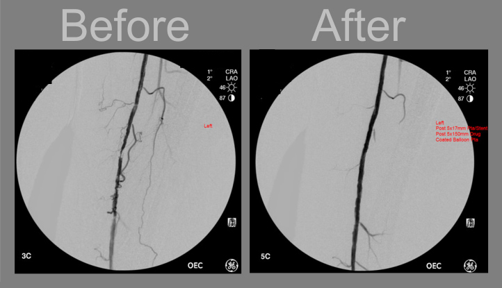 Angiography