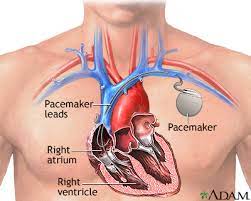 heart-pacemakers